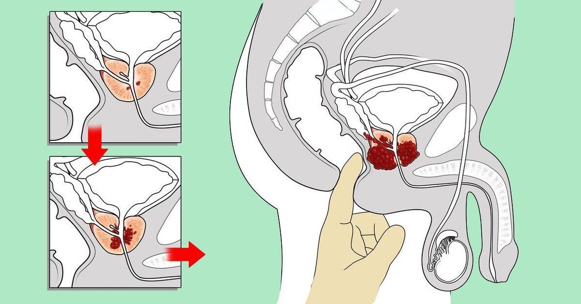 come massaggiare la prostata